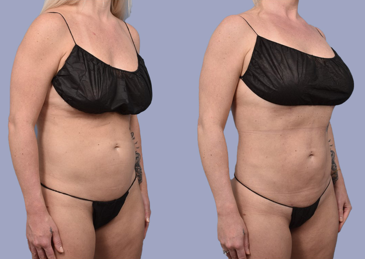 Abdominal Flank Liposuction Gallery Dr Michael Stein